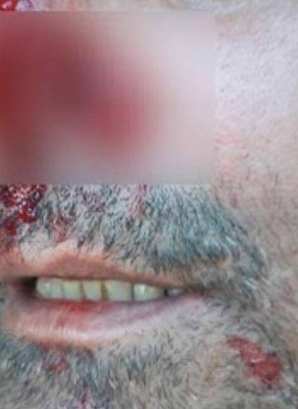 ¡Ñandejara! De un mordisco le arrancó la nariz a su papá