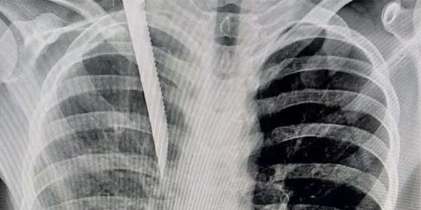 LE PERFORARON UN PULMÓN A ADOLESCENTE VENDEDOR - Itapúa Noticias
