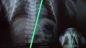 Papá denunció que fracturaron clavícula a su beba al nacer