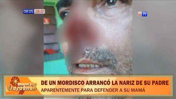 Joven arranca la nariz a su padre en defensa de su madre