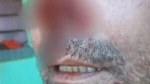 De un mordisco arrancó la nariz de su papá para defender a su mamá