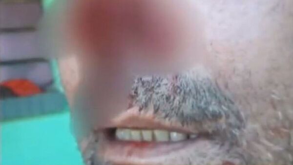 De un mordisco arrancó la nariz de su papá para defender a su mamá