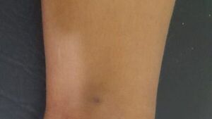 Niño de 3 años fue mordido por víbora y le trasladaron a Asunción