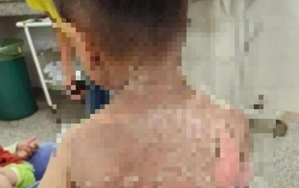 Niño de 3 años se quemó con agua caliente en Concepción – Prensa 5