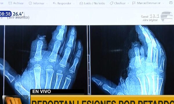 Niño de 4 años pierde un dedo tras explosión de pirotecnia - Paraguaype.com