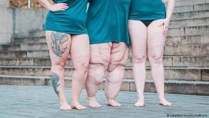Lipedema no es lo mismo que obesidad ¿Cómo diferenciarlas?