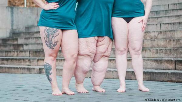 Lipedema no es lo mismo que obesidad ¿Cómo diferenciarlas?
