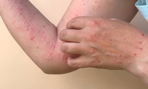 Salud reporta más de 50 casos de viruela del mono en el país - OviedoPress