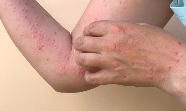Salud reporta más de 50 casos de viruela del mono en el país - OviedoPress