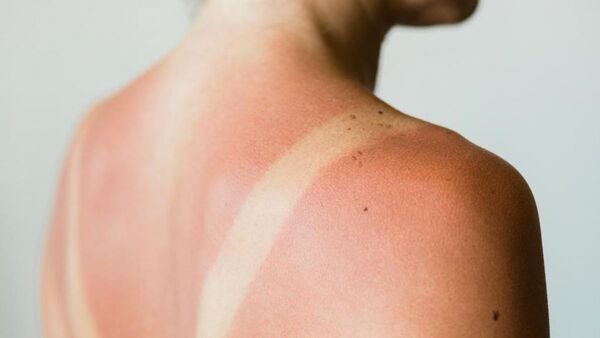 ¿Cómo aliviar las quemaduras de sol?