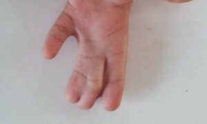 Albañil ahorró para cirugía de su hijo y asaltantes se lo llevaron