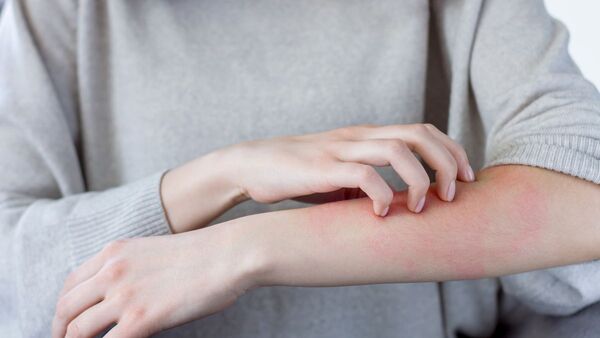 Dermatitis atópica: Nuevos paradigmas en el tratamiento para pacientes