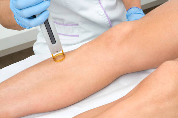 Depilación láser: Dermatóloga de Clínicas hace una serie de recomendaciones » San Lorenzo PY