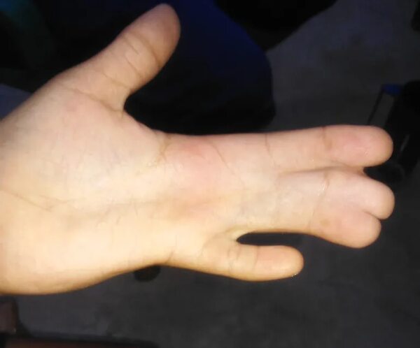 Exitosa operación al hijo del albañil al que robaron dinero para la cirugía - Nacionales - ABC Color