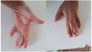 Niño sometido a cirugía de mano tras robo evoluciona y pronto tendrá el alta 