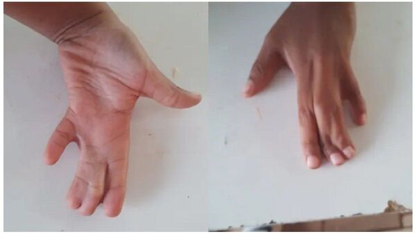 Niño sometido a cirugía de mano tras robo evoluciona y pronto tendrá el alta