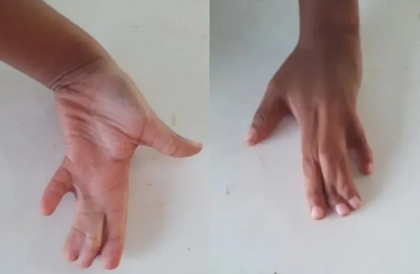 Niño saldrá de alta esta semana tras exitosa cirugía de mano