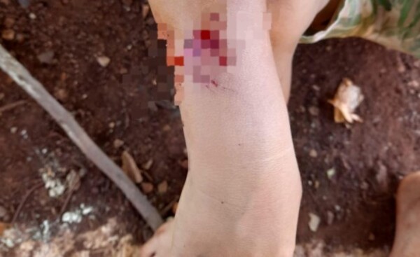 Niño abandonado con una herida por mordedura de perro