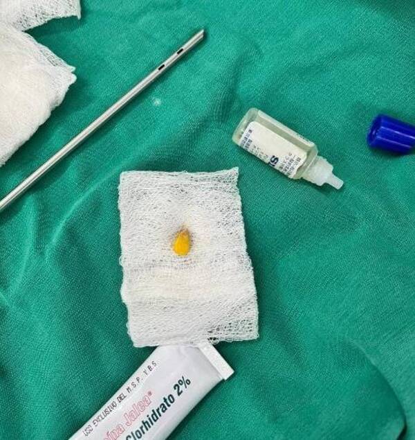 [VIDEO] Niño de un añito aspiró grano de maíz y fue a parar al hospital