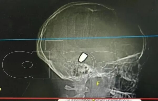 Bala perdida en Pedro Juan Caballero: niña fue intervenida y está en coma inducido - Policiales - ABC Color