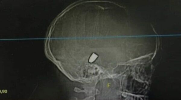 Niña recibió una bala perdida y la atendieron como si tuviera un golpe en la cabeza