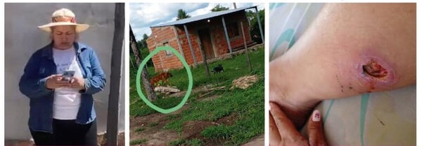 Víctima de omisión de auxilio por la mordida del perro de camarista implora justicia - PDS RADIO Y TV