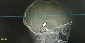 Niña de 13 años fue víctima de una bala perdida y se encuentra en grave estado - Noticiero Paraguay