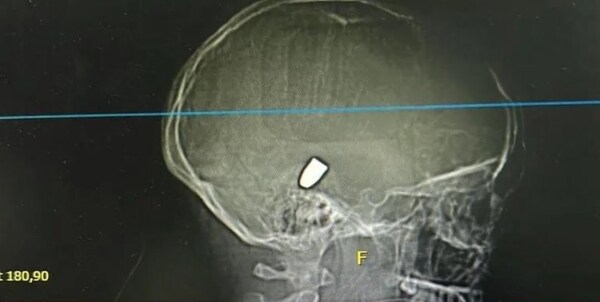Niña de 13 años fue víctima de una bala perdida y se encuentra en grave estado - Noticiero Paraguay