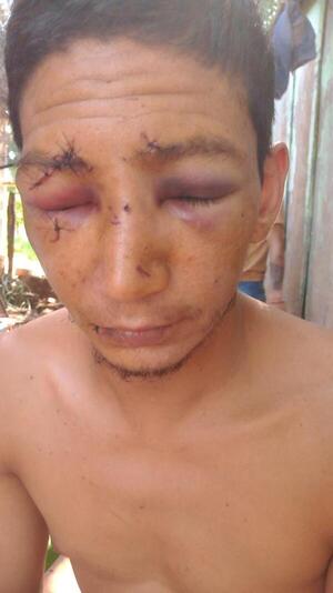Hombre quedó prácticamente desfigurado tras ser agredido con una botella en Puerto Triunfo