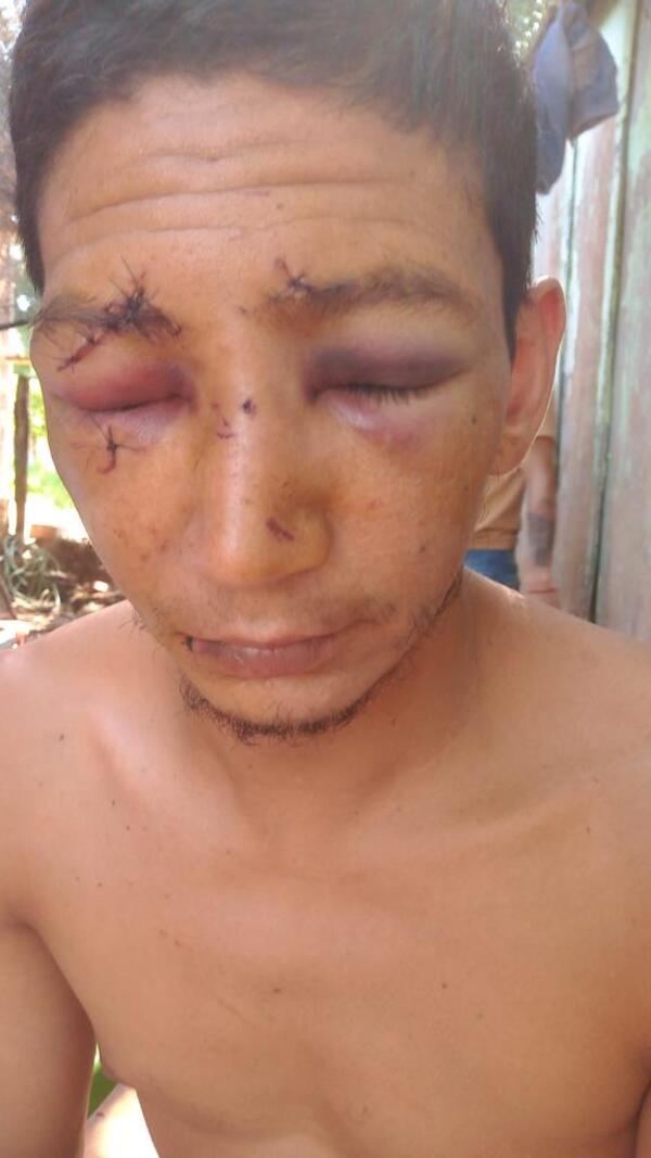 Hombre quedó prácticamente desfigurado tras ser agredido con una botella en Puerto Triunfo