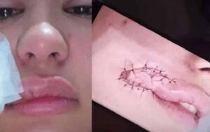 Turista paraguaya fue mordida por asaltante en Brasil – Prensa 5