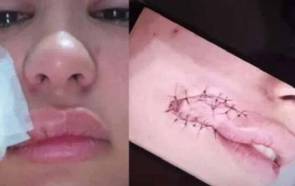 Turista paraguaya fue mordida por asaltante en Brasil – Prensa 5