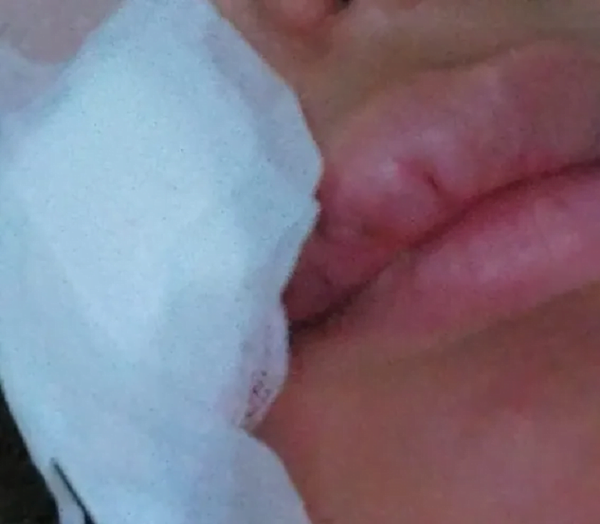 Brasil: ladrón mordió a turista paraguaya en la cara y le provocó herida de 14 puntos - Noticiero Paraguay