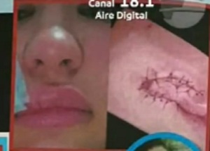 Vacaciones de terror: Paraguaya fue mordida por un asaltante en Brasil - Noticias Paraguay