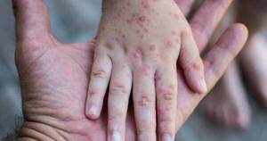La Nación / Sequera advierte que el sarampión es una de las enfermedades más contagiosas