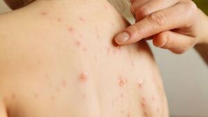 Escasa cobertura de vacunación puede ser un factor de rebrote de sarampión | 1000 Noticias