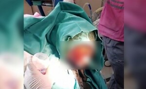 IMPACTANTE: niña de cuatro años tiene la cabeza llena de gusanos