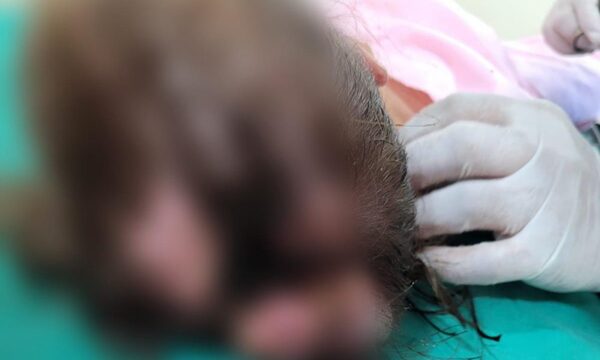 Diario HOY | Niña de 4 años con la cabeza agusanada fue internada en hospital de CDE