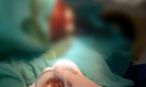 Niña fue sometida a cirugía para extracción de gusanos