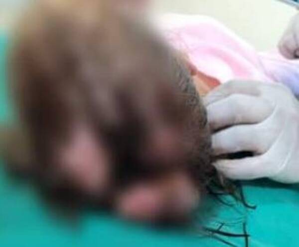 ¡De terror! Nena de 4 años llegó al hospital con la cabecita totalmente agusanada