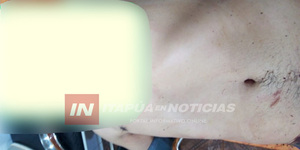 TRAS DISCUSIÓN CON SU PAREJA SE INTENTÓ SUICIDAR - Itapúa Noticias