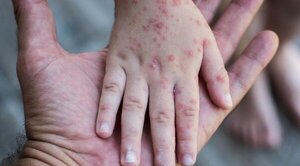 OMS lanza alerta por sarampión, Paraguay tiene un caso confirmado