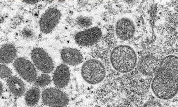 Salud reporta 92 casos confirmados de la viruela del mono, todos en hombres - OviedoPress