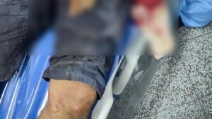 Le cortaron la mano en una riña