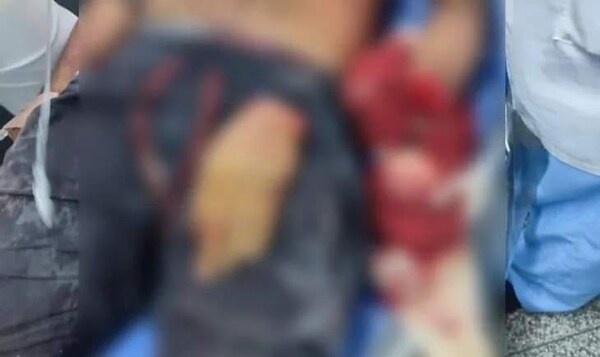 Le cortaron la mano en una riña con un machete - Noticiero Paraguay