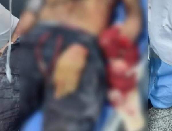 Le cortaron la mano con machete en una pelea