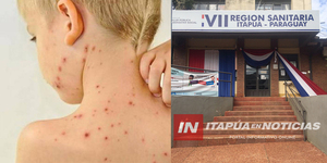 SECTOR DE SALUD EN ITAPÚA TOMA ACCIONES ANTE CASOS DE SOSPECHOSOS DE SARAMPIÓN - Itapúa Noticias