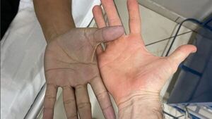 Joven se desesperó porque sus manos se pusieron azules