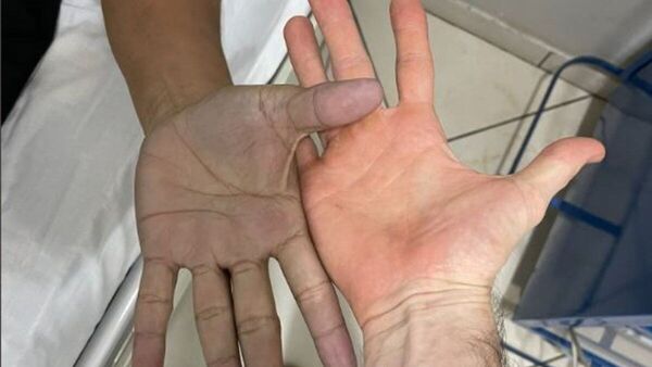 Joven se desesperó porque sus manos se pusieron azules