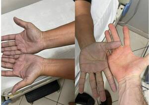Tenía las manos azuladas, fue a urgencias y era solo culpa del jeans